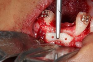regeneración ósea dental innovation