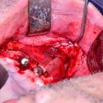 Implantologia avanzada Implantes Cigomaticos