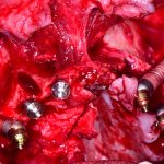 Implantologia avanzada Implantes Cigomaticos