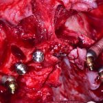 curso Implantes Cigomaticos