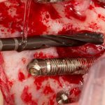 curso Implantes Cigomaticos