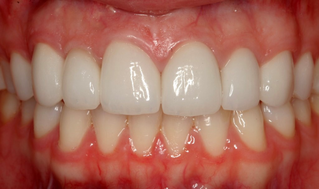 sonrisa con cirugia plastica periodontal