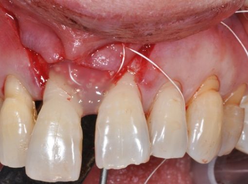Apollonia Chirurgia parodontale rigenerativa 5