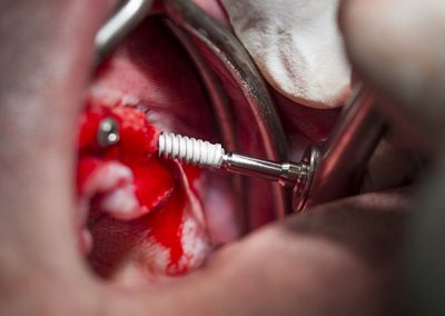 Residencia Clínica de Implantología y Cirugía Oral en Brasil