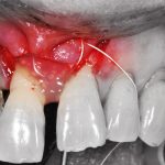 curso clinico periodoncia y cirugia plastica periodontal dental innovation brasil