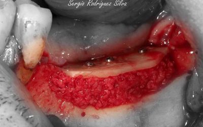 curso cirugias pacientes khoury dental innovation