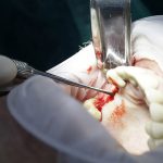 estancia clinica implantologia madrid con pacientes practica dental innovation